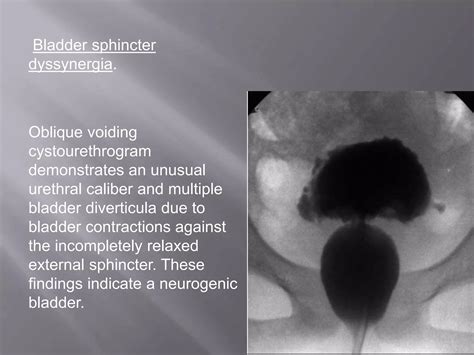 what is mcu in hospital|Micturating Cystourethrogram (MCU) .